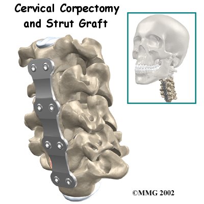 Cervical Corpectomy and Strut Graft